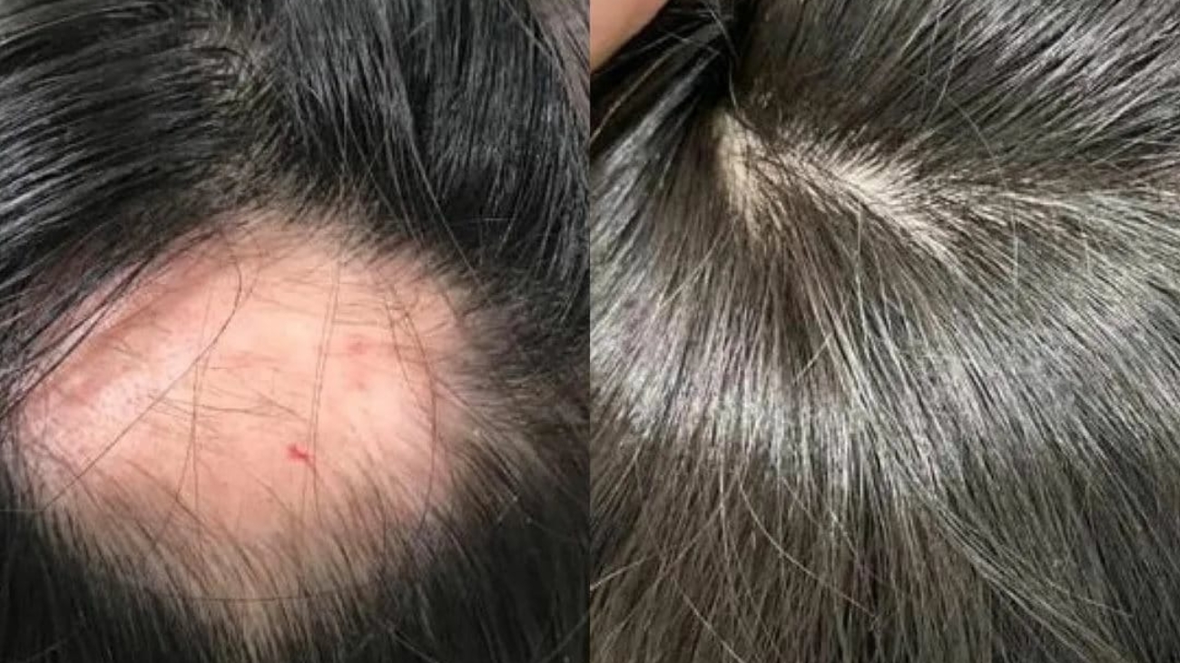 مدة زراعة الشعر في تركيا