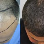 زراعة الشعر في الرياض