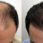 زراعة الشعر في السعودية