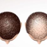 زراعة الشعر في فرنسا