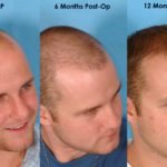 طرق عملية زراعة الشعر
