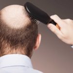 زراعة الشعر في بريطانيا