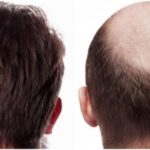 أنواع طرق زراعة الشعر