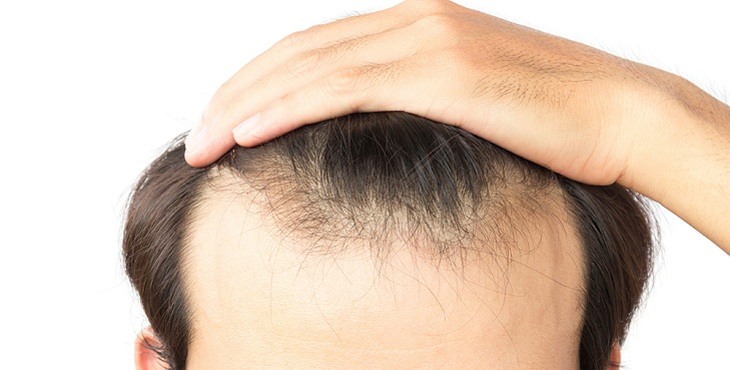 أنواع طرق زراعة الشعر