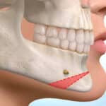 تجميل الذقن