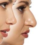 تصغير فتحات الأنف