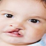 تكلفة عملية تجميل الشفة الأرنبية