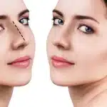 أسعار تصغير الأنف بالليزر