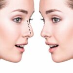 أنواع عمليات تجميل الأنف