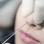 تقنية البيزو لتجميل الانف