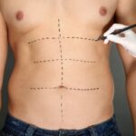 عملية تجميل البطن