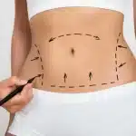 عملية تجميل السرة